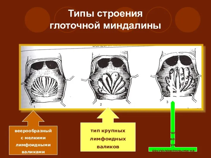 Типы строения глоточной миндалины 1-веерообразный с мелкими лимфоидными валиками 2 –