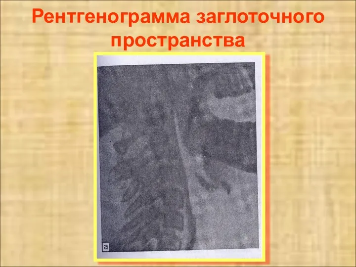 Рентгенограмма заглоточного пространства