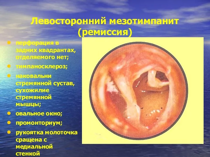 Левосторонний мезотимпанит (ремиссия) перфорация в задних квадрантах, отделяемого нет; тимпаносклероз; наковальни