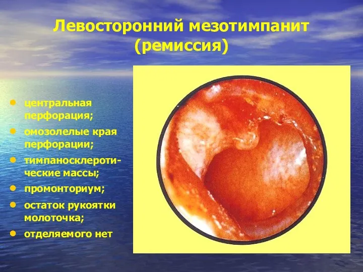 Левосторонний мезотимпанит (ремиссия) центральная перфорация; омозолелые края перфорации; тимпаносклероти-ческие массы; промонториум; остаток рукоятки молоточка; отделяемого нет