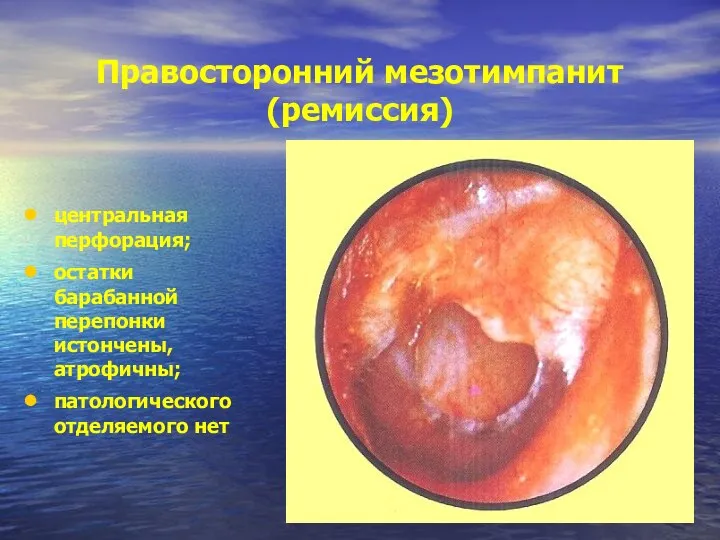 Правосторонний мезотимпанит (ремиссия) центральная перфорация; остатки барабанной перепонки истончены, атрофичны; патологического отделяемого нет