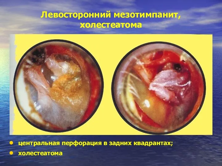 Левосторонний мезотимпанит, холестеатома центральная перфорация в задних квадрантах; холестеатома