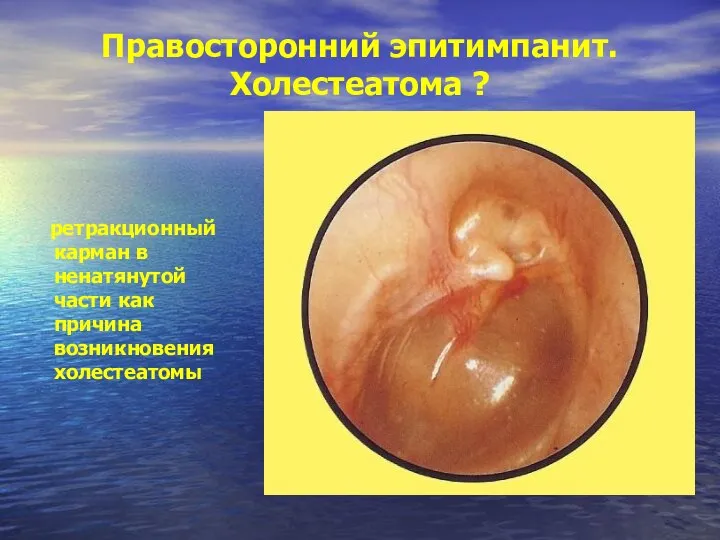 Правосторонний эпитимпанит. Холестеатома ? ретракционный карман в ненатянутой части как причина возникновения холестеатомы