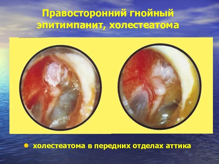 Правосторонний гнойный эпитимпанит, холестеатома холестеатома в передних отделах аттика