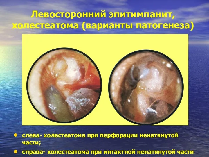 Левосторонний эпитимпанит, холестеатома (варианты патогенеза) слева- холестеатома при перфорации ненатянутой части;