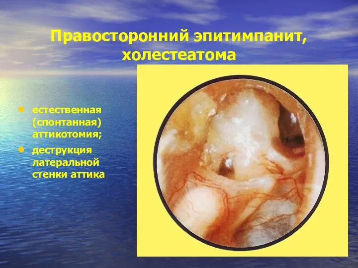 Правосторонний эпитимпанит, холестеатома естественная (спонтанная) аттикотомия; деструкция латеральной стенки аттика