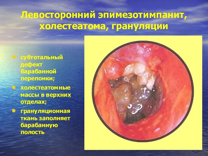 Левосторонний эпимезотимпанит, холестеатома, грануляции субтотальный дефект барабанной перепонки; холестеатомные массы в