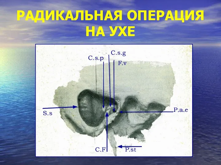 РАДИКАЛЬНАЯ ОПЕРАЦИЯ НА УХЕ Р.а.е Р.st S.s F.v C.F C.s.g C.s.p