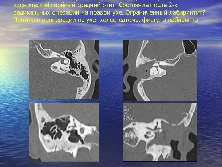 Пациент М., 52г. Поступила с диагнозом: правосторонний хронический гнойный средний отит.