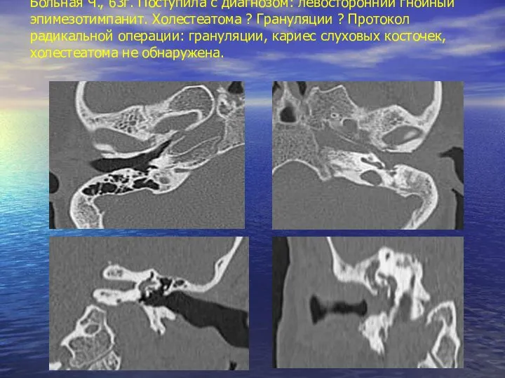 Больная Ч., 63г. Поступила с диагнозом: левосторонний гнойный эпимезотимпанит. Холестеатома ?