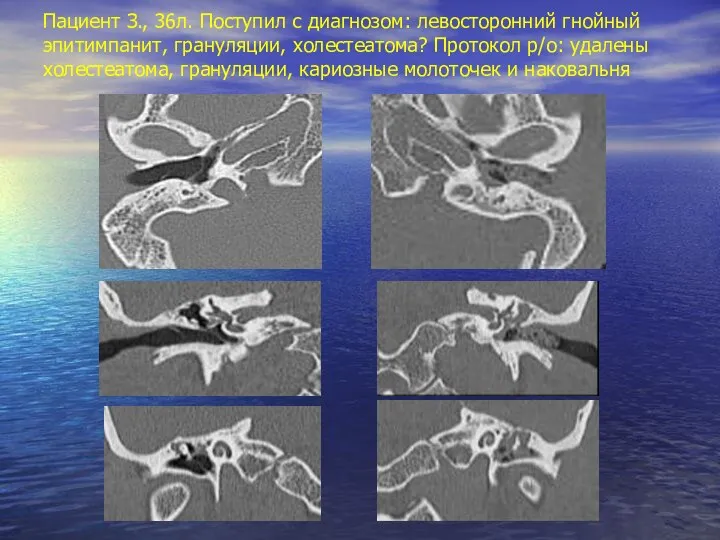 Пациент З., 36л. Поступил с диагнозом: левосторонний гнойный эпитимпанит, грануляции, холестеатома?