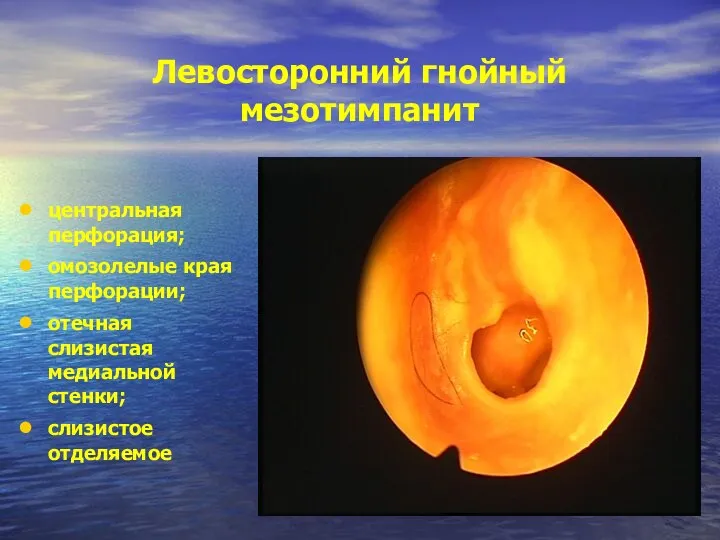 Левосторонний гнойный мезотимпанит центральная перфорация; омозолелые края перфорации; отечная слизистая медиальной стенки; слизистое отделяемое