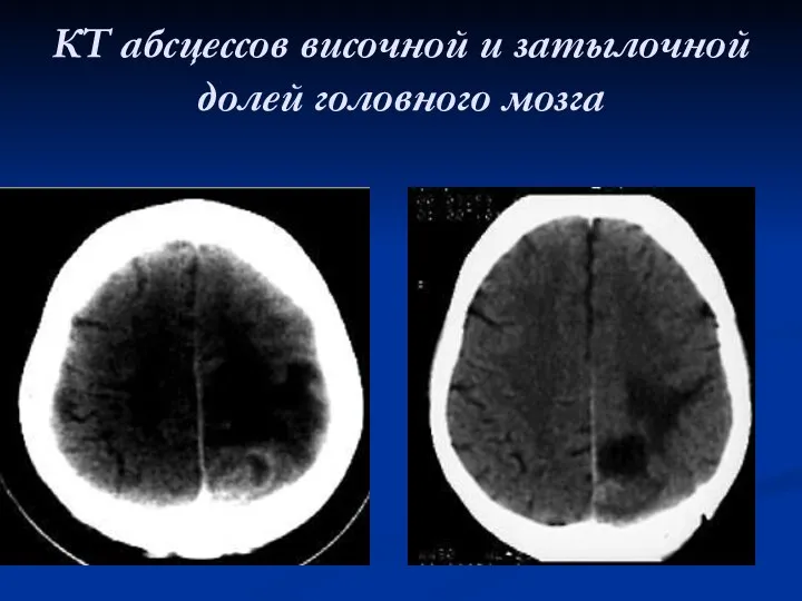 КТ абсцессов височной и затылочной долей головного мозга