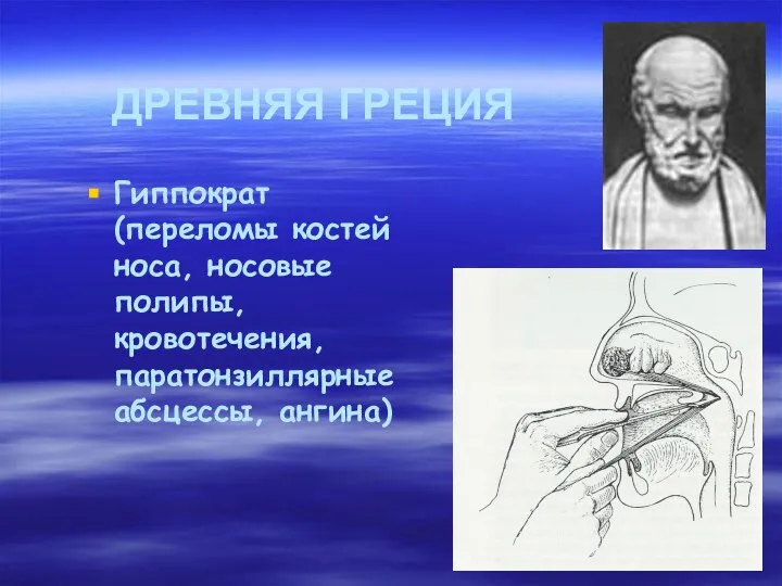 ДРЕВНЯЯ ГРЕЦИЯ Гиппократ (переломы костей носа, носовые полипы, кровотечения, паратонзиллярные абсцессы, ангина)