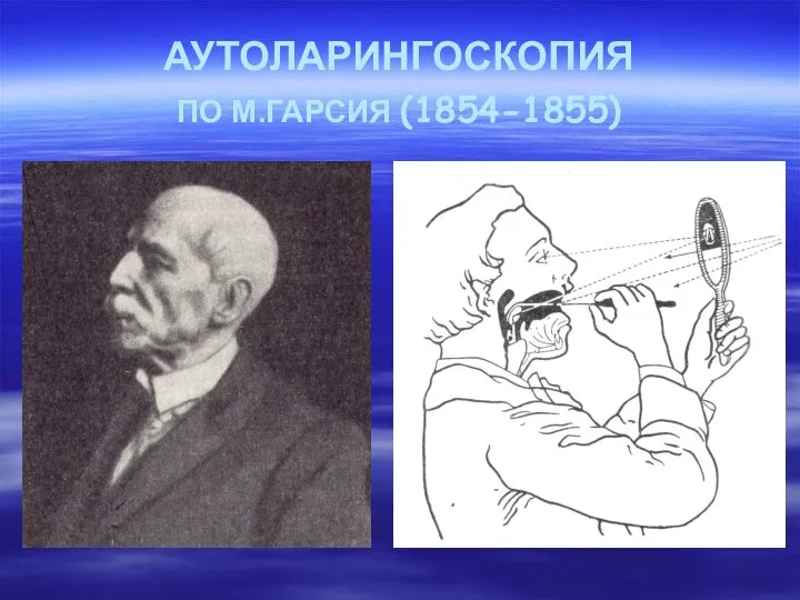 АУТОЛАРИНГОСКОПИЯ ПО М.ГАРСИЯ (1854-1855)