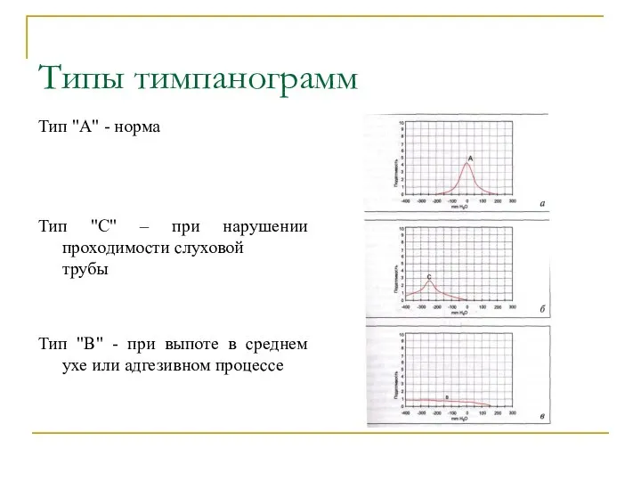 Типы тимпанограмм Тип "А" - норма Тип "С" – при нарушении