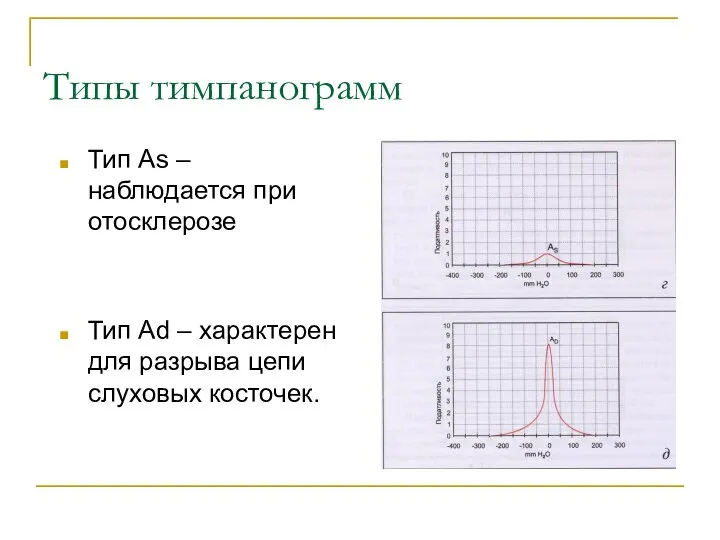 Типы тимпанограмм Тип As – наблюдается при отосклерозе Тип Аd –