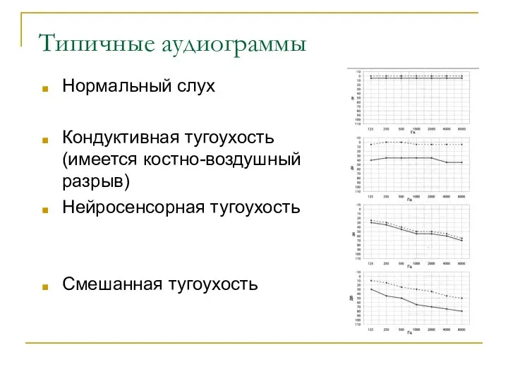 Типичные аудиограммы Нормальный слух Кондуктивная тугоухость (имеется костно-воздушный разрыв) Нейросенсорная тугоухость Смешанная тугоухость