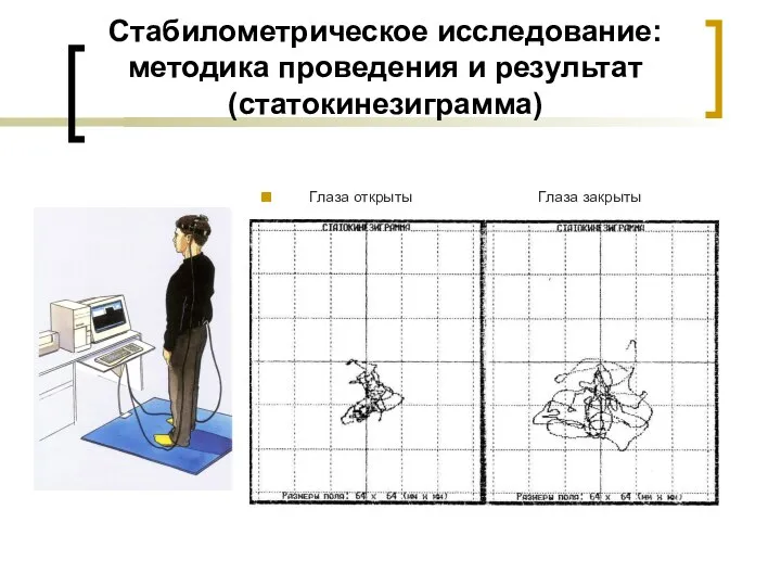 Стабилометрическое исследование:методика проведения и результат (статокинезиграмма) Глаза открыты Глаза закрыты