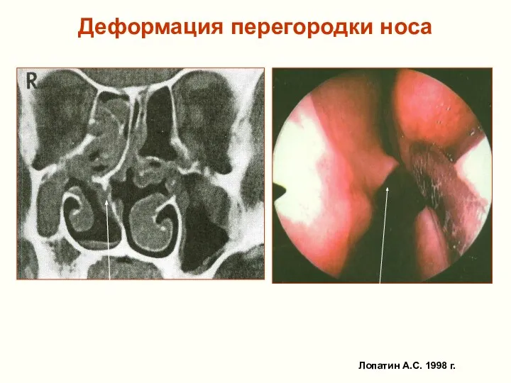 Деформация перегородки носа Лопатин А.С. 1998 г.