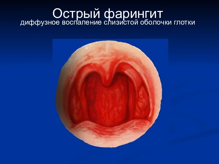 Острый фарингит диффузное воспаление слизистой оболочки глотки