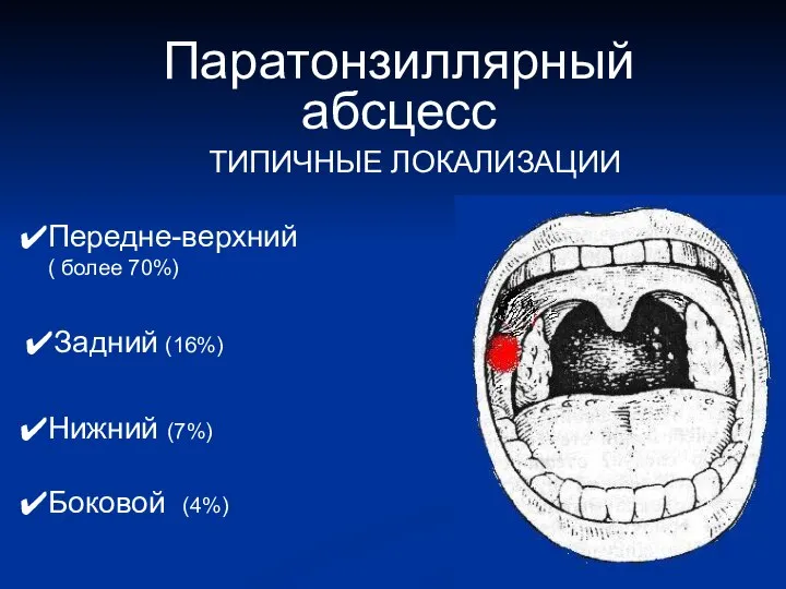 Паратонзиллярный абсцесс ТИПИЧНЫЕ ЛОКАЛИЗАЦИИ Передне-верхний ( более 70%) Задний (16%) Нижний (7%) Боковой (4%)