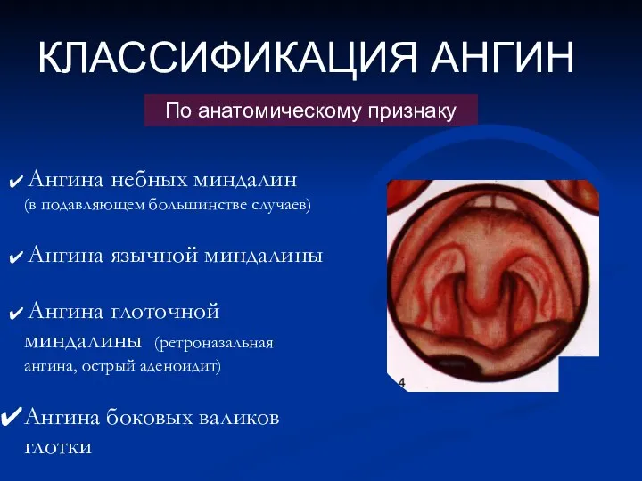 КЛАССИФИКАЦИЯ АНГИН По анатомическому признаку Ангина небных миндалин (в подавляющем большинстве