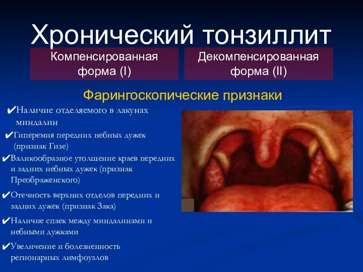 Хронический тонзиллит Компенсированная форма (I) Декомпенсированная форма (II) Фарингоскопические признаки Наличие