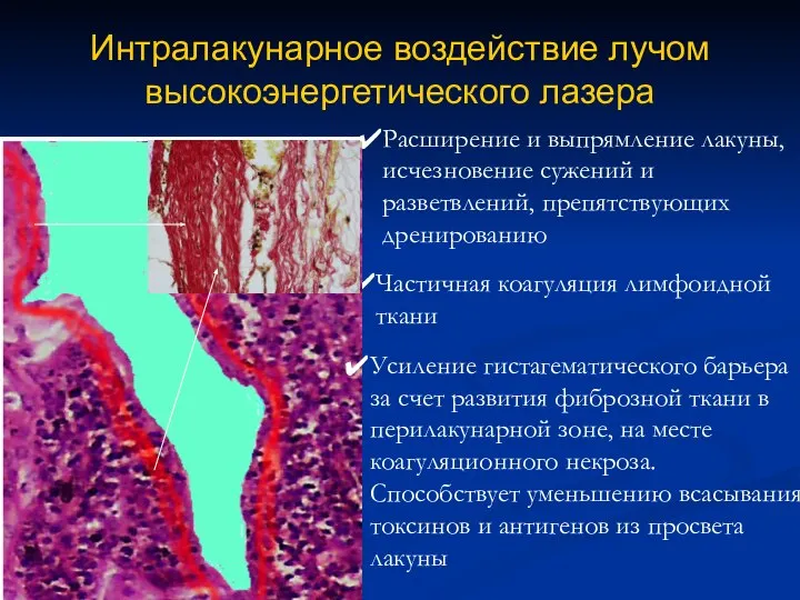 Интралакунарное воздействие лучом высокоэнергетического лазера Расширение и выпрямление лакуны, исчезновение сужений