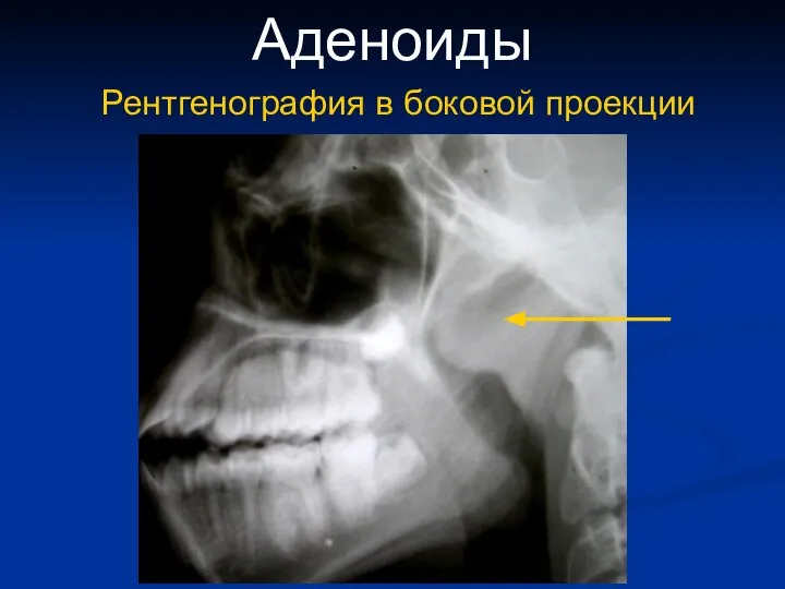 Аденоиды Рентгенография в боковой проекции