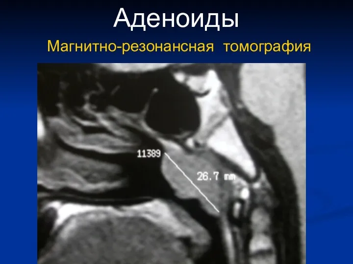 Аденоиды Магнитно-резонансная томография