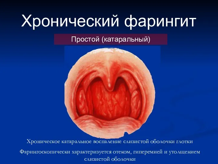 Хронический фарингит Простой (катаральный) Хроническое катаральное воспаление слизистой оболочки глотки Фарингоскопически