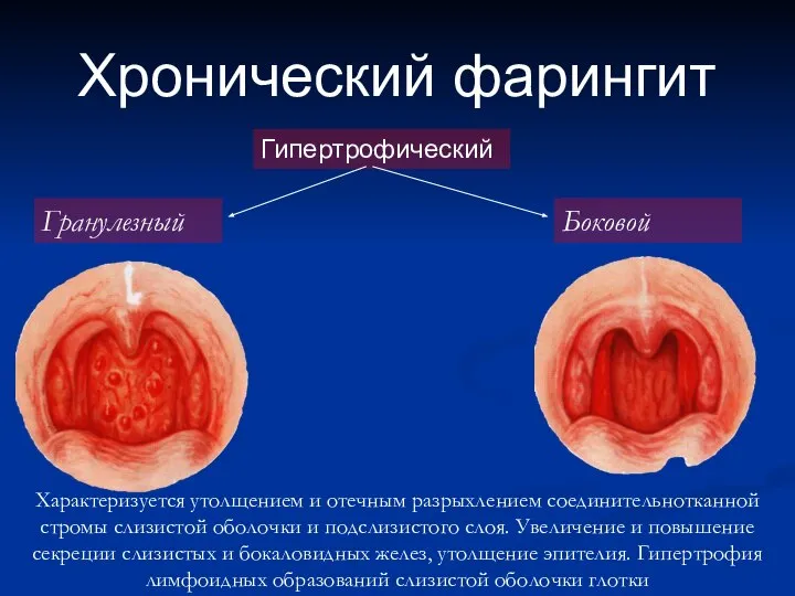 Хронический фарингит Гипертрофический Гранулезный Боковой Характеризуется утолщением и отечным разрыхлением соединительнотканной