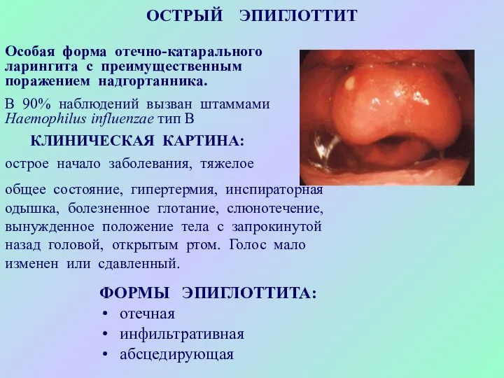 ОСТРЫЙ ЭПИГЛОТТИТ Особая форма отечно-катарального ларингита с преимущественным поражением надгортанника. В