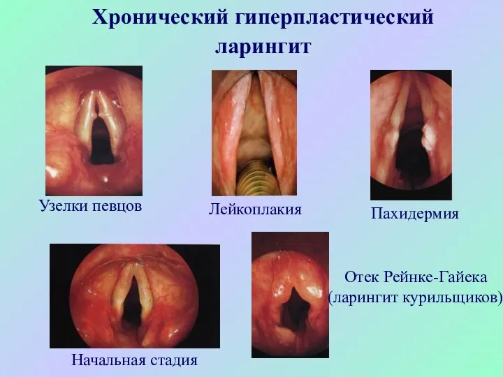 Хронический гиперпластический ларингит Узелки певцов Отек Рейнке-Гайека (ларингит курильщиков) Лейкоплакия Пахидермия Начальная стадия