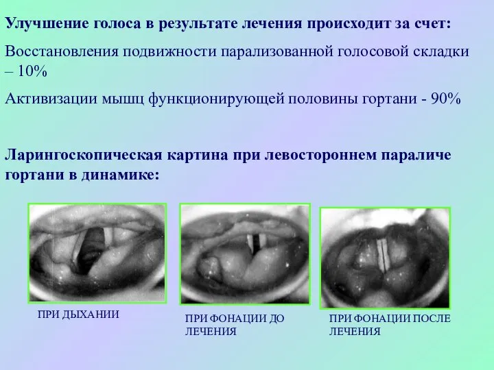 Улучшение голоса в результате лечения происходит за счет: Восстановления подвижности парализованной