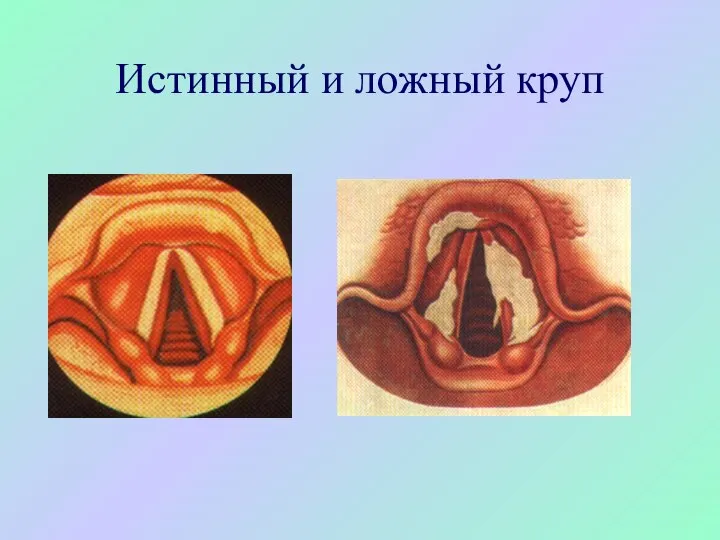 Истинный и ложный круп