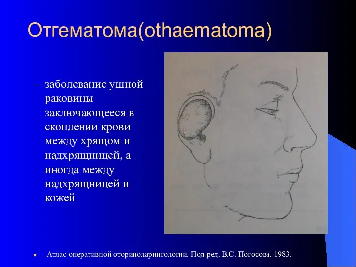 Отгематома(othaematoma) заболевание ушной раковины заключающееся в скоплении крови между хрящом и
