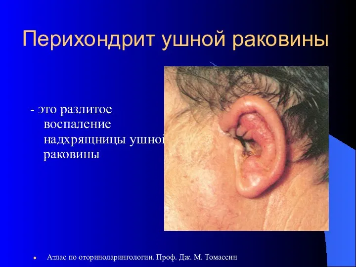 Перихондрит ушной раковины - это разлитое воспаление надхрящницы ушной раковины Атлас