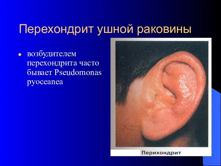 Перехондрит ушной раковины возбудителем перехондрита часто бывает Pseudomonas pyoceanea