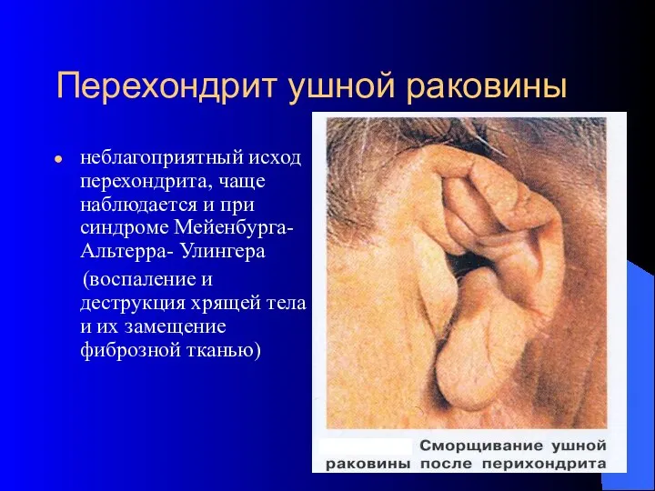 Перехондрит ушной раковины неблагоприятный исход перехондрита, чаще наблюдается и при синдроме
