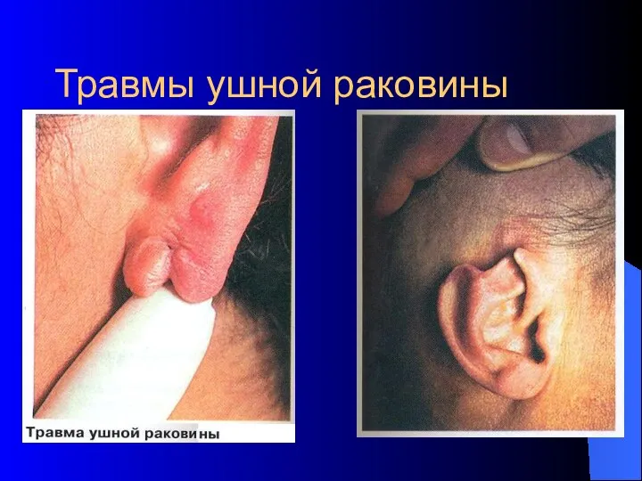Травмы ушной раковины