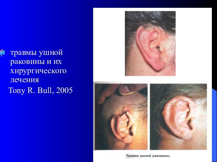 травмы ушной раковины и их хирургического лечения Tony R. Bull, 2005