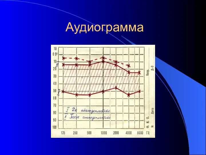 Аудиограмма