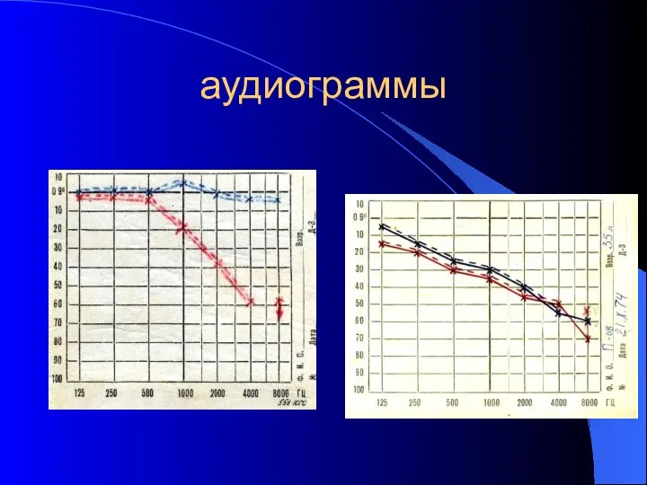 аудиограммы