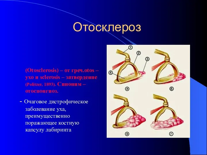 Отосклероз (Otosclerosis) – от греч.otos – ухо и sclerosis – затвердение