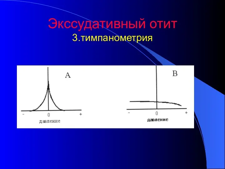 Экссудативный отит 3.тимпанометрия