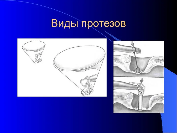 Виды протезов