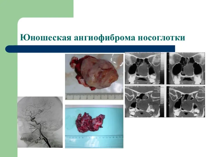 Юношеская ангиофиброма носоглотки