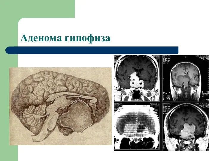 Аденома гипофиза